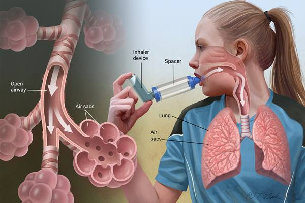 Hati-Hati, Ini Efek Samping Inhaler Bagi Penderita Asma