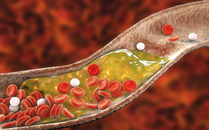 Hati-Hati! Ini 3 Jenis Kolesterol Dalam Tubuh yang Patut Dikenali